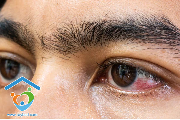 دلایل قرمزی چشم