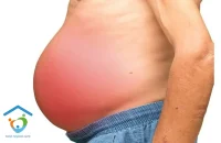 تخلیه مایع اسیت شکم