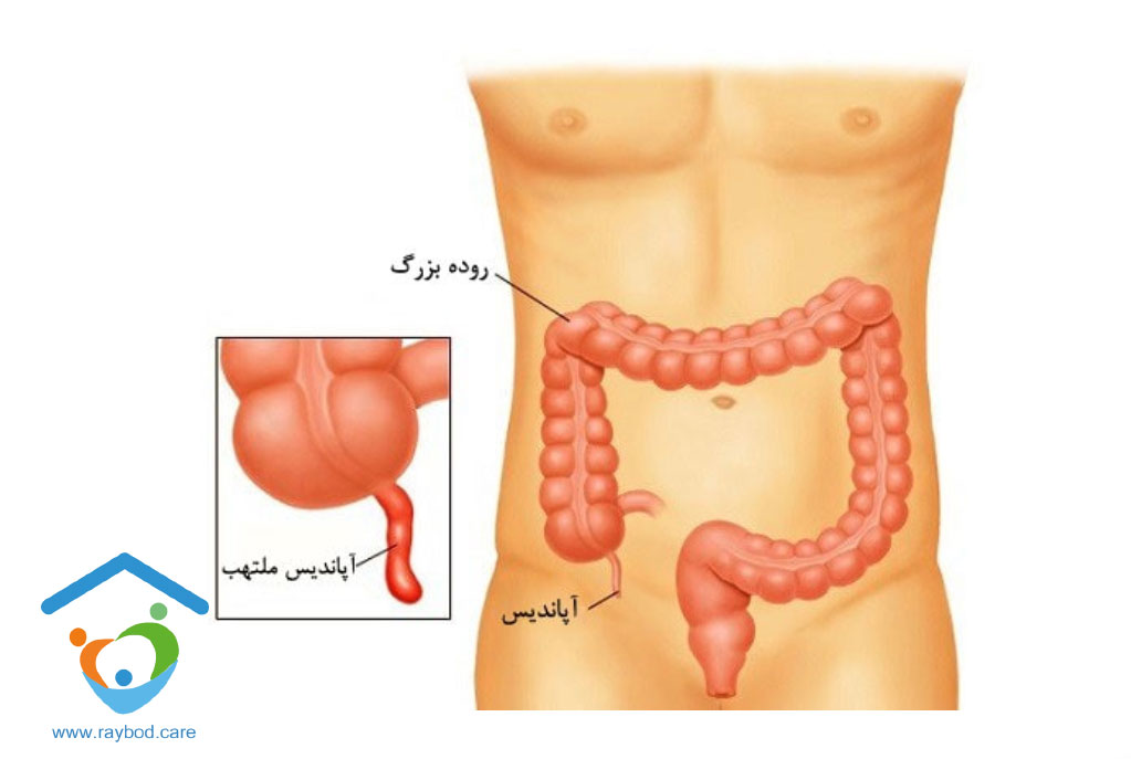 التهاب حاد آپاندیست و علائم آن