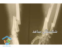 عمل جراحی ساعد دست
