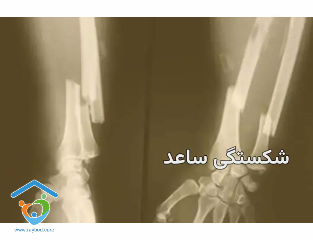 عمل جراحی ساعد دست
