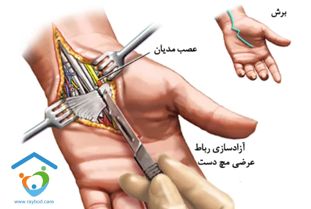 علائم سندرم تونل کارپال