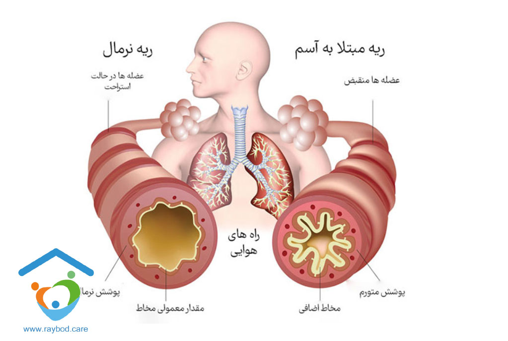 علل و عوامل خطر آسم