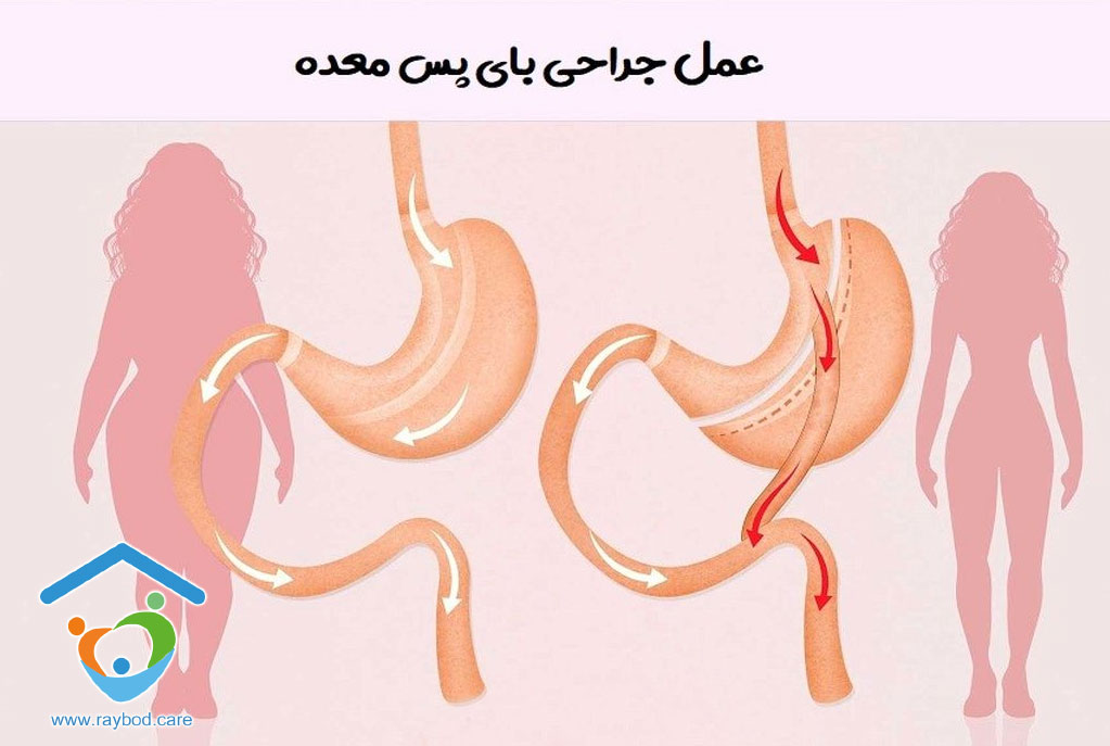 بای پس معده و مراقبت‌های بعد از عمل در منزل و سرم تراپی