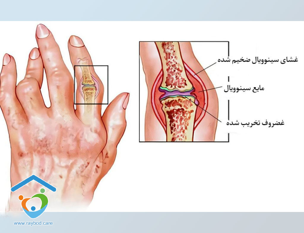 بیماری روماتیسم چیست