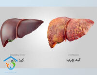 منظور از بیماری کبد چرب چیست ؟
