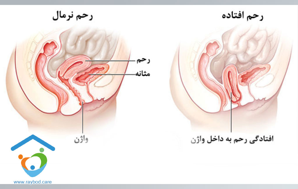 روش‌های درمان افتادگی رحم